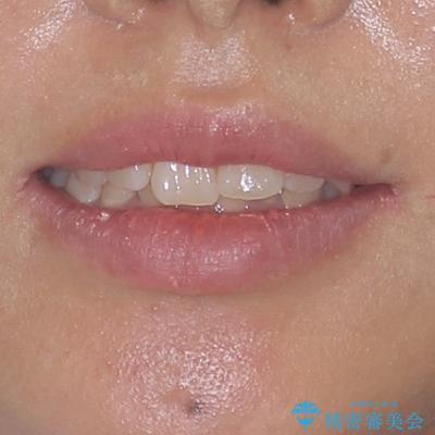 インビザラインが続けられない ワイヤー矯正に切り替えてデコボコを改善の治療前(顔貌)