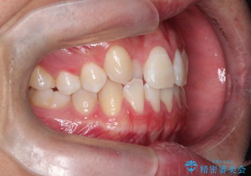 正中の改善と前歯の整列:抜歯を伴う矯正治療の症例の治療前