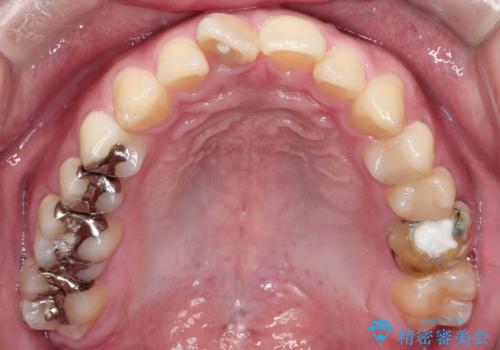 【インビザライン 非抜歯】歯の捻じれと歯のでこぼこを治したい!の治療前