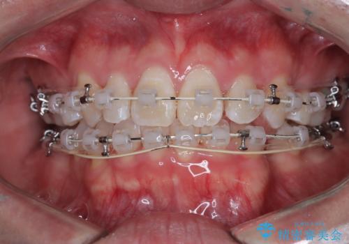 正中の改善と前歯の整列:抜歯を伴う矯正治療の症例の治療中
