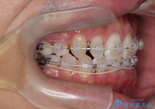 正中の改善と前歯の整列:抜歯を伴う矯正治療の症例の治療中