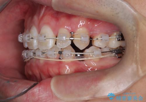 正中の改善と前歯の整列:抜歯を伴う矯正治療の症例の治療中