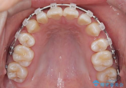 正中の改善と前歯の整列:抜歯を伴う矯正治療の症例の治療中