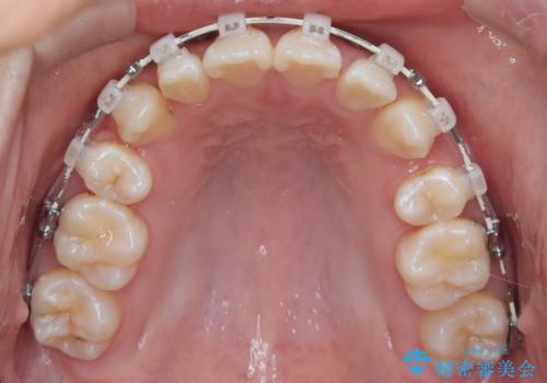 正中の改善と前歯の整列:抜歯を伴う矯正治療の症例の治療中