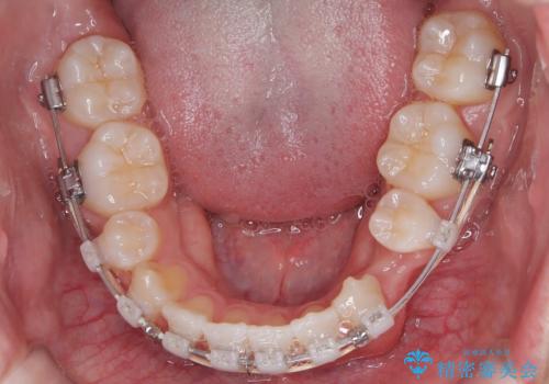 正中の改善と前歯の整列:抜歯を伴う矯正治療の症例の治療中