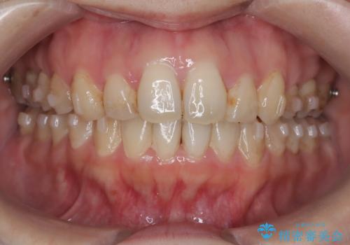 インビザラインによる前歯のガタガタ改善治療の治療中