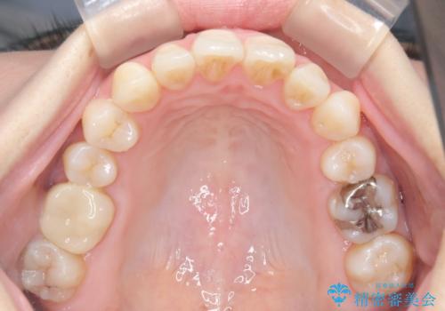 インビザラインによる前歯のガタガタ改善治療の治療後