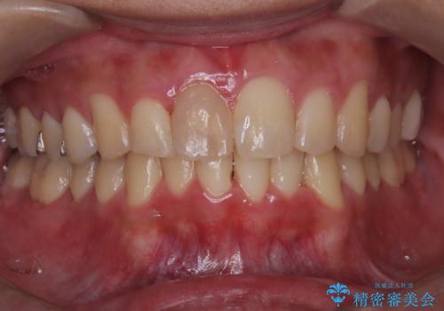 【インビザライン 非抜歯】歯の捻じれと歯のでこぼこを治したい!の治療中