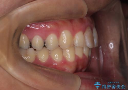 【インビザライン 非抜歯】歯の捻じれと歯のでこぼこを治したい!の治療中