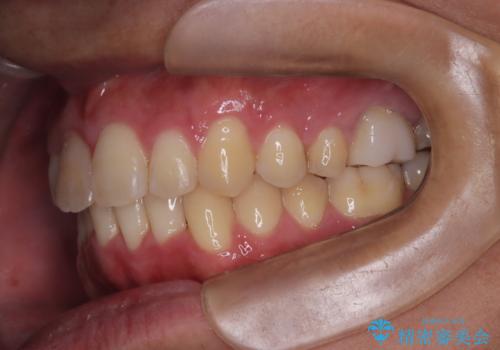 【インビザライン 非抜歯】歯の捻じれと歯のでこぼこを治したい!の治療中