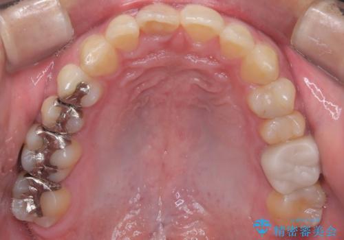【インビザライン 非抜歯】歯の捻じれと歯のでこぼこを治したい!の治療中