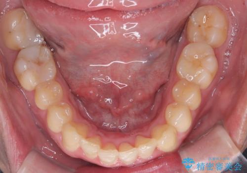 【インビザライン 非抜歯】歯の捻じれと歯のでこぼこを治したい!の治療中