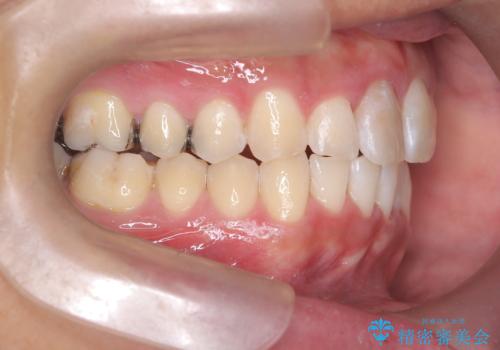 【インビザライン 非抜歯】歯の捻じれと歯のでこぼこを治したい!の治療後