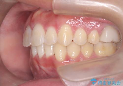 【インビザライン 非抜歯】歯の捻じれと歯のでこぼこを治したい!の治療後