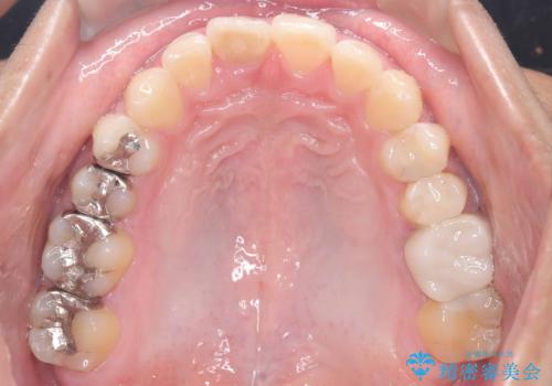 【インビザライン　非抜歯】歯の捻じれと歯のでこぼこを治したい!の治療後