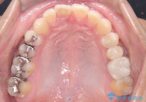 【インビザライン 非抜歯】歯の捻じれと歯のでこぼこを治したい!の治療後