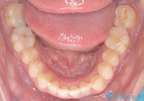 【インビザライン 非抜歯】歯の捻じれと歯のでこぼこを治したい!の治療後