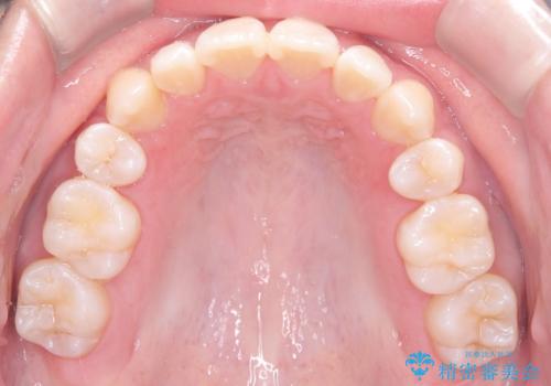 正中の改善と前歯の整列:抜歯を伴う矯正治療の症例の治療後