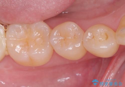 セラミックインレーによる虫歯治療の治療前