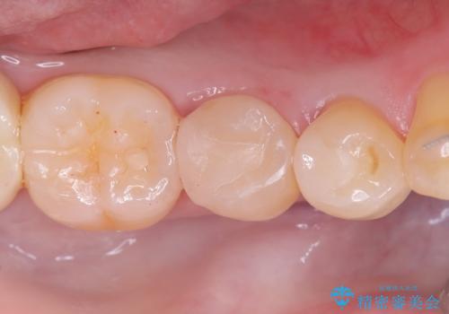 セラミックインレーによる虫歯治療の治療後