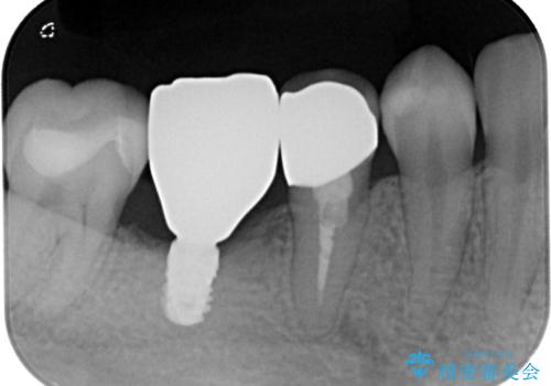 銀歯をやり替えたい。インプラントとセラミックによる治療の治療後