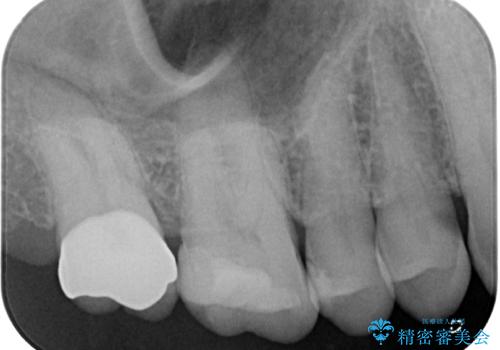 食事中に歯が欠けたので治したい。オールセラミッククラウンによる補綴の治療後