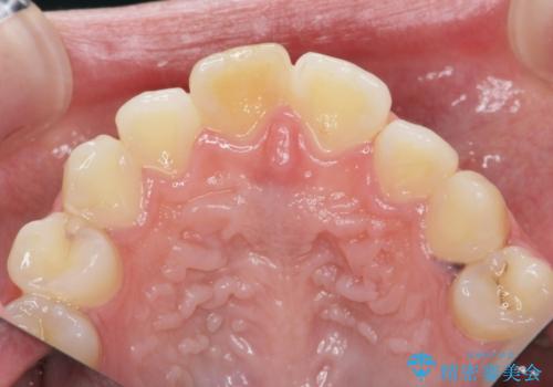 前歯の変色をキレイに セラミッククラウン審美治療の治療前