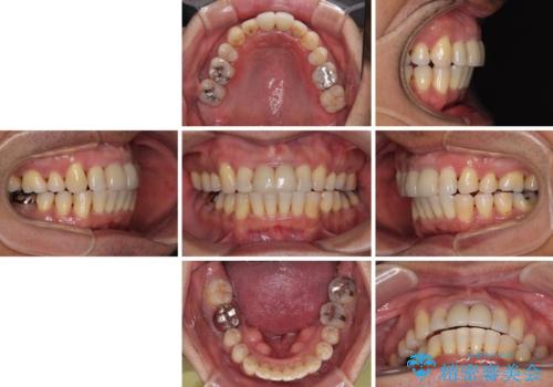 八重歯と突出感を改善　ワイヤー装置での矯正治療の治療後