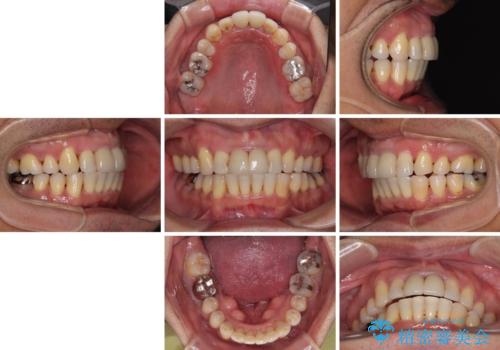 八重歯と突出感を改善 ワイヤー装置での矯正治療の治療後