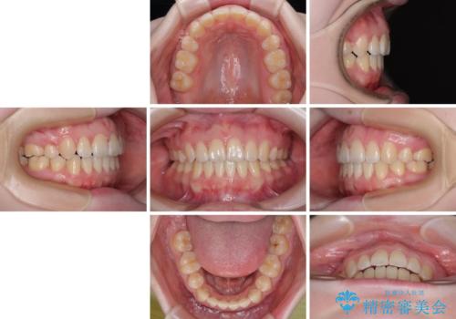 飛び出した上顎前歯　抜歯矯正で横顔の印象を改善の治療後