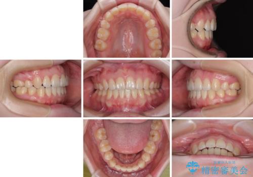 飛び出した上顎前歯 抜歯矯正で横顔の印象を改善の治療後