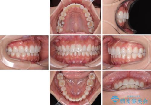 【モニター】前歯のデコボコと小さい前歯 インビザライン矯正とオールセラミッククラウン補綴治療の治療後