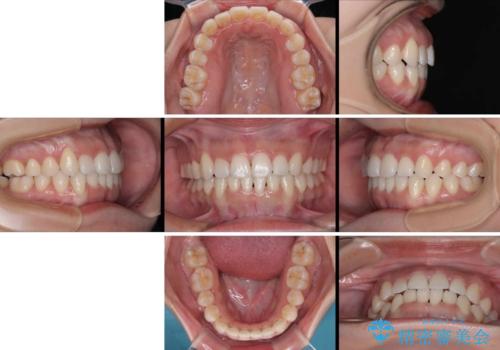 急速拡大装置　狭い歯列を拡大して短期間での矯正治療の治療後