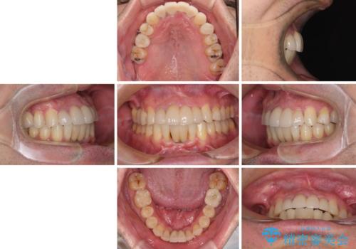 放置した歯列　矯正治療とインプラント治療で劇的に改善の治療後