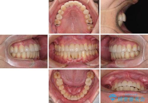 放置した歯列 矯正治療とインプラント治療で劇的に改善の治療後