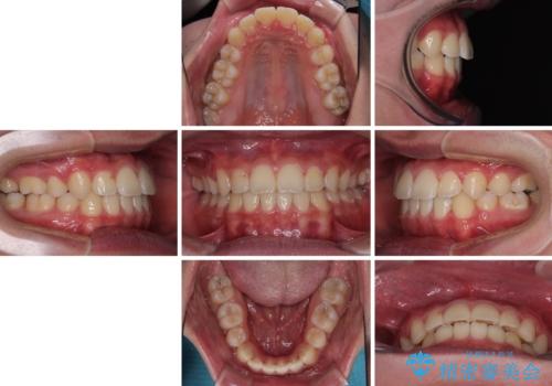 突出した口元 ワイヤー装置で横顔の印象を改善の治療後