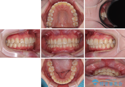 インビザラインが続けられない　ワイヤー矯正に切り替えてデコボコを改善の治療後