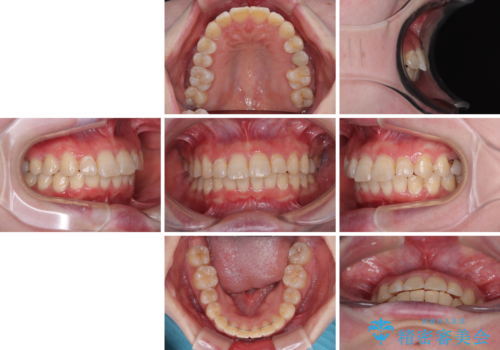 インビザラインが続けられない ワイヤー矯正に切り替えてデコボコを改善の治療後