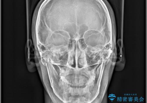 【インビザライン 非抜歯】歯の捻じれと歯のでこぼこを治したい!の治療後