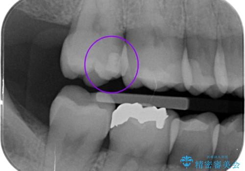 歯と歯の間の虫歯の治療。(コンタクトカリエス)の治療前