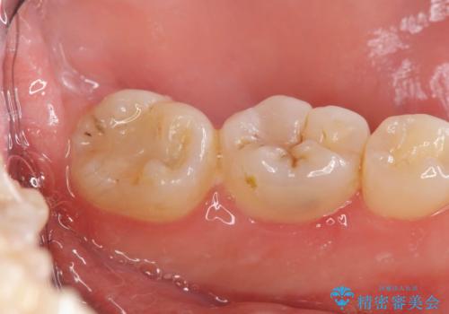 歯冠長延長術をおこなったアプローチの難しい虫歯治療の治療中