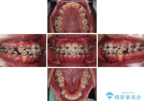 突出した口元 ワイヤー装置で横顔の印象を改善の治療中