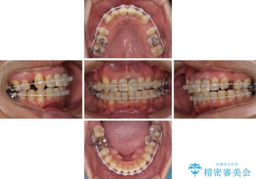 八重歯と突出感を改善　ワイヤー装置での矯正治療の治療中