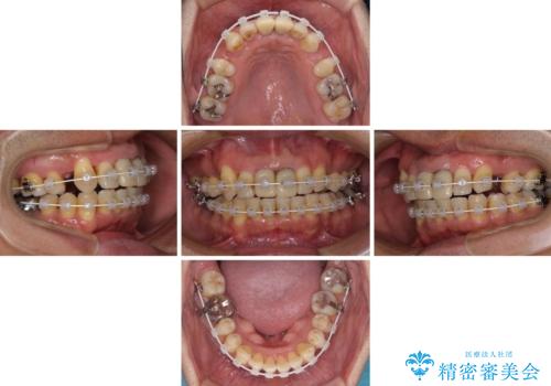 八重歯と突出感を改善 ワイヤー装置での矯正治療の治療中