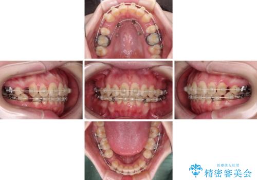 飛び出した上顎前歯　抜歯矯正で横顔の印象を改善の治療中