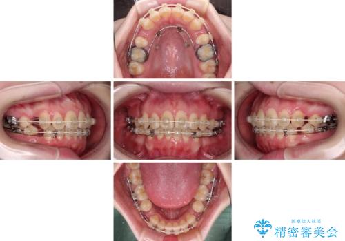 飛び出した上顎前歯 抜歯矯正で横顔の印象を改善の治療中