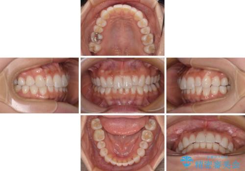 【モニター】前歯のデコボコと小さい前歯 インビザライン矯正とオールセラミッククラウン補綴治療の治療中