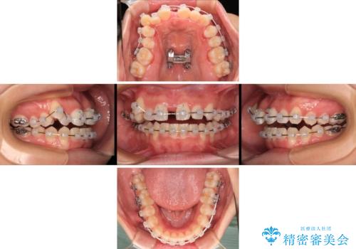 急速拡大装置　狭い歯列を拡大して短期間での矯正治療の治療中