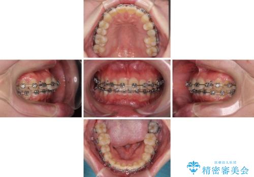 インビザラインが続けられない　ワイヤー矯正に切り替えてデコボコを改善の治療中