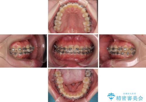 インビザラインが続けられない ワイヤー矯正に切り替えてデコボコを改善の治療中
